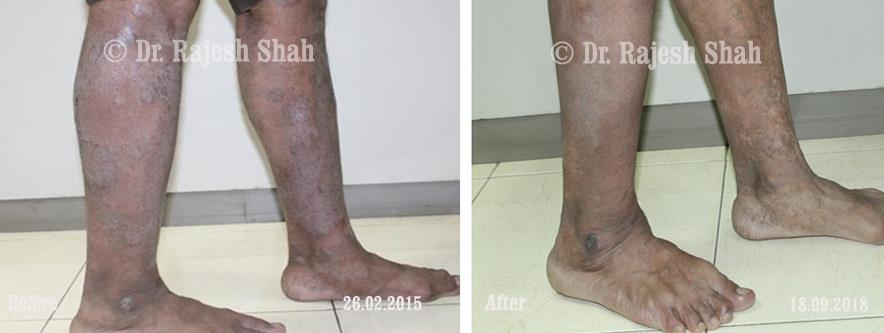 Psoriasis Before and After Case Photo