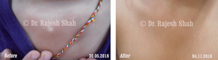 Vitiligo Before and After Case Photo