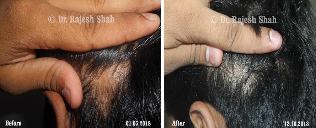 Alopecia Areata Before and After Case Photo