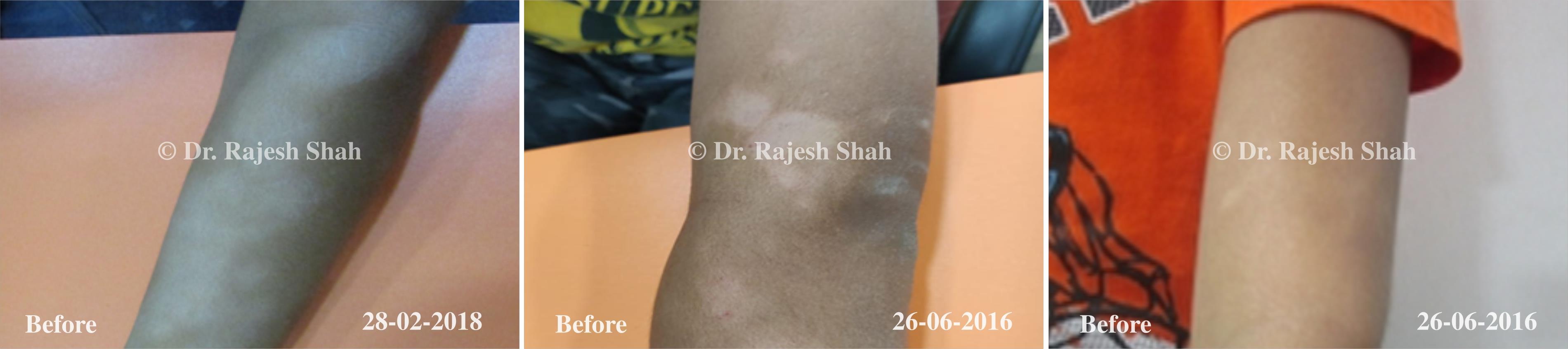 Pityriasis Alba Before and After Case Photo