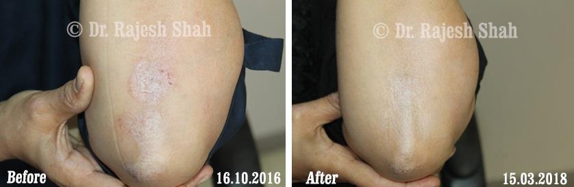 Psoriasis Before and After Case Photo