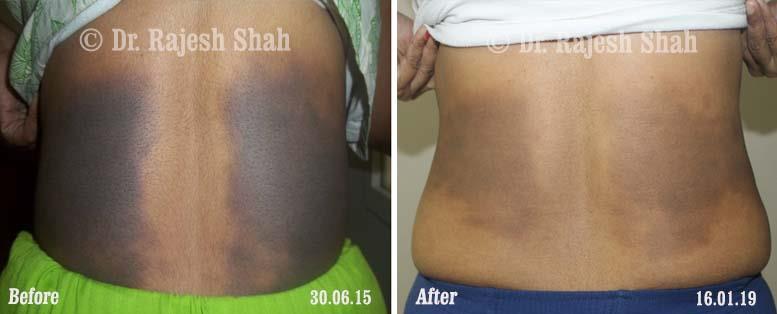 Lichen Planus Before and After Case Photo