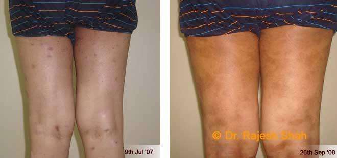 Psoriasis Before and After Case Photo