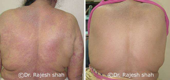 Psoriasis Before and After Case Photo
