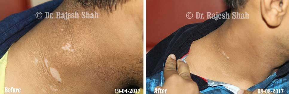 Vitiligo Before and After Case Photo