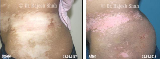 Vitiligo Before and After Case Photo