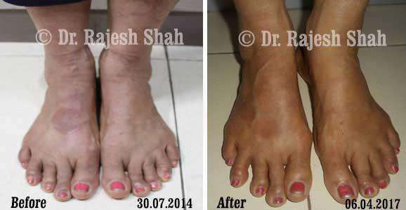 Granuloma Annulare Before and After Case Photo