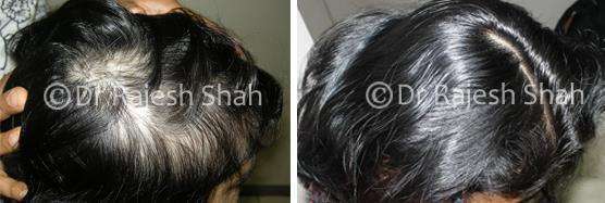 Alopecia Areata Before and After Case Photo
