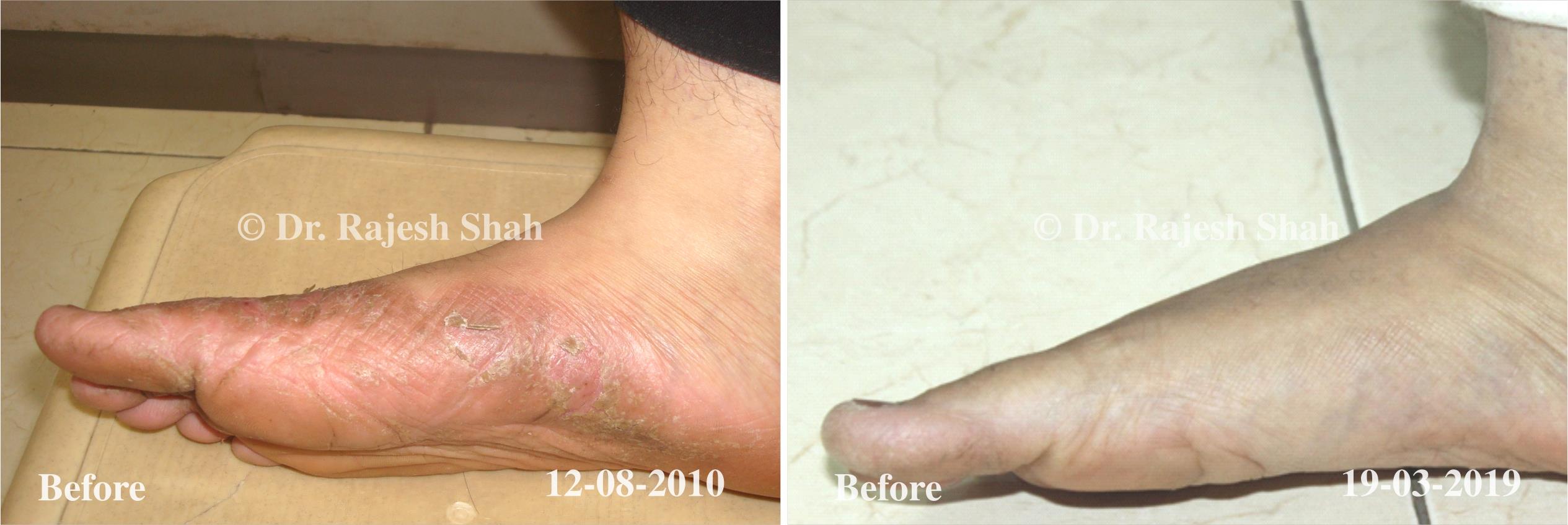 Psoriasis Before and After Case Photo