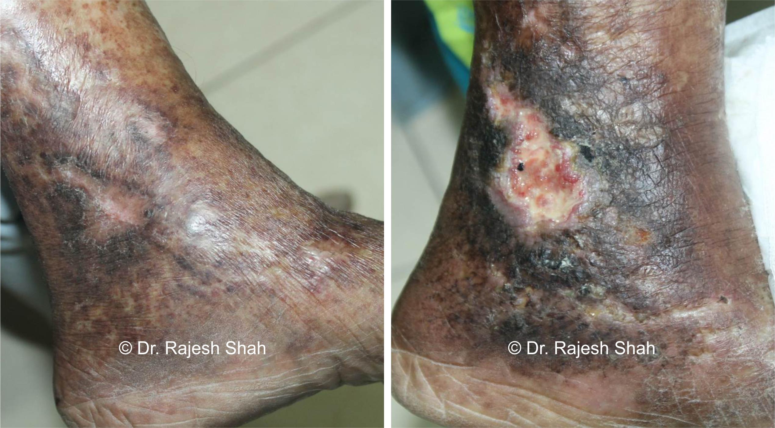 Non-healing ulcers Before and After Case Photo