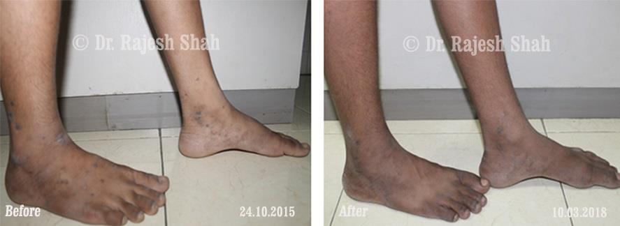 Lichen Planus Before and After Case Photo