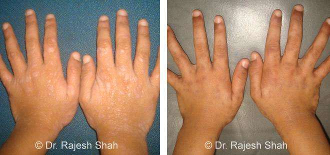 Lichen Planus Before and After Case Photo