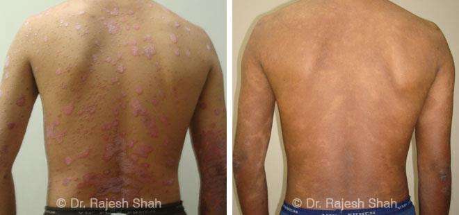 Psoriasis Before and After Case Photo
