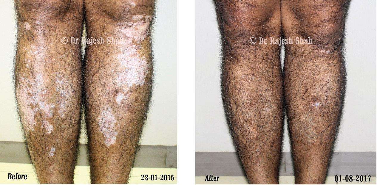 Vitiligo Before and After Case Photo