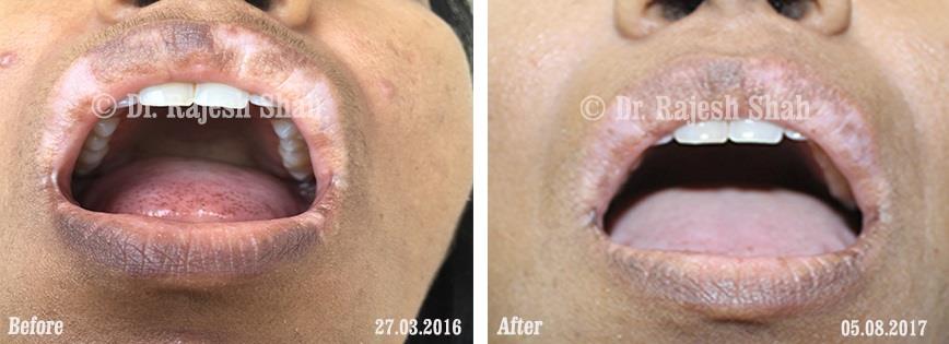 Vitiligo Before and After Case Photo