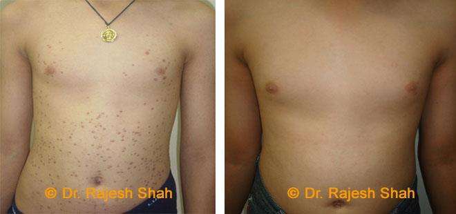 Lichen Planus Before and After Case Photo