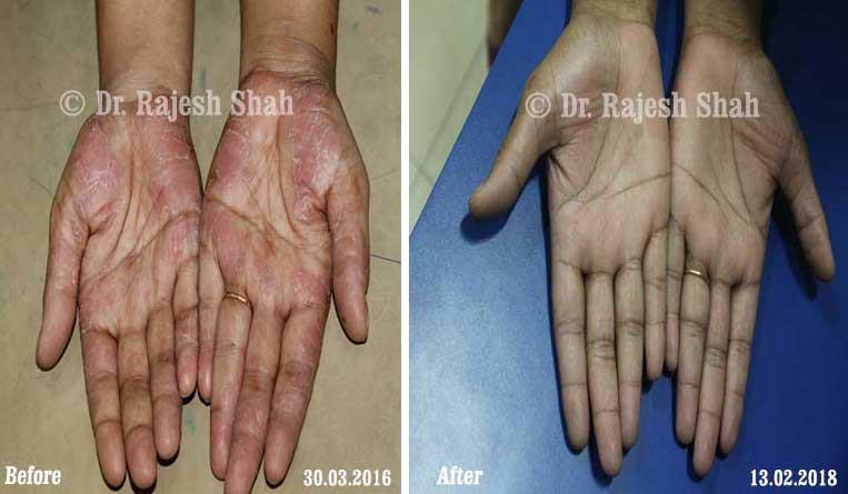 Psoriasis Before and After Case Photo