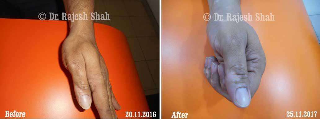 Vitiligo Before and After Case Photo