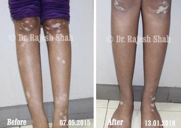 Vitiligo Before and After Case Photo