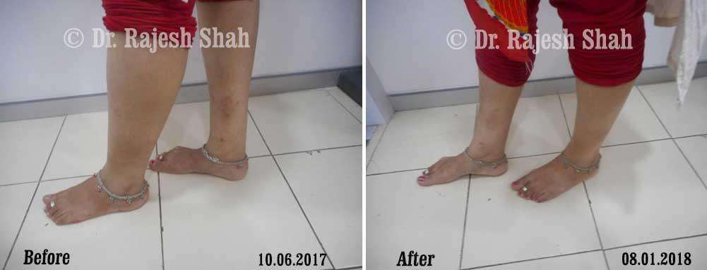 Psoriasis Before and After Case Photo