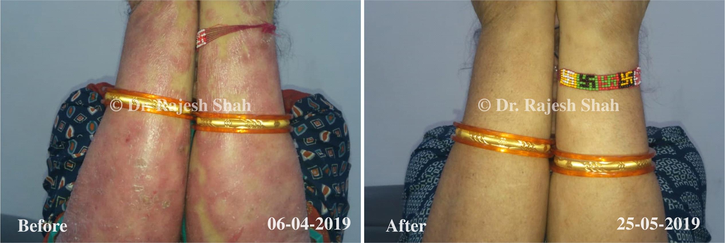 Psoriasis Before and After Case Photo