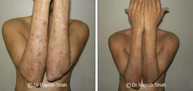 Psoriasis Before and After Case Photo