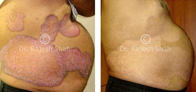 Psoriasis Before and After Case Photo