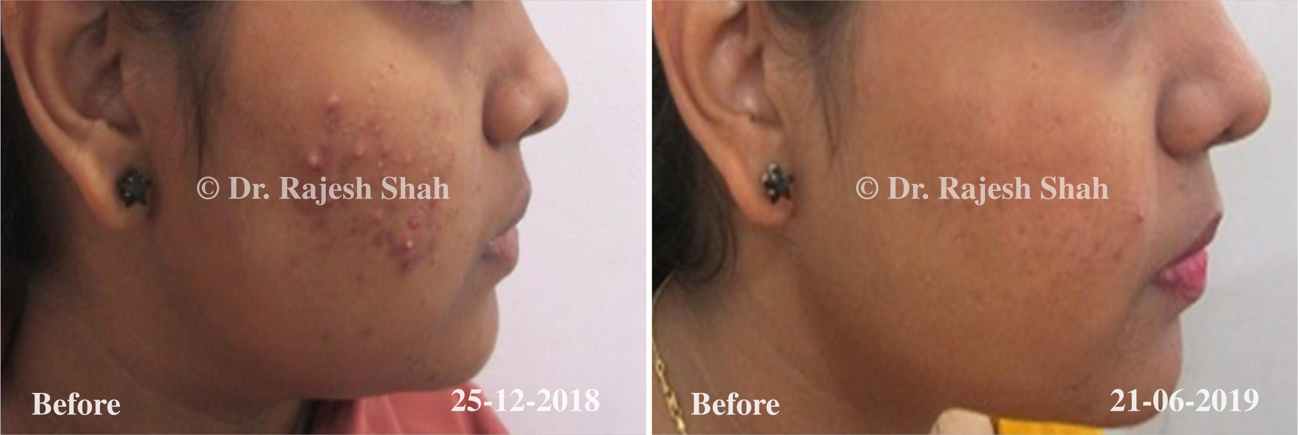 Acne Before and After Case Photo