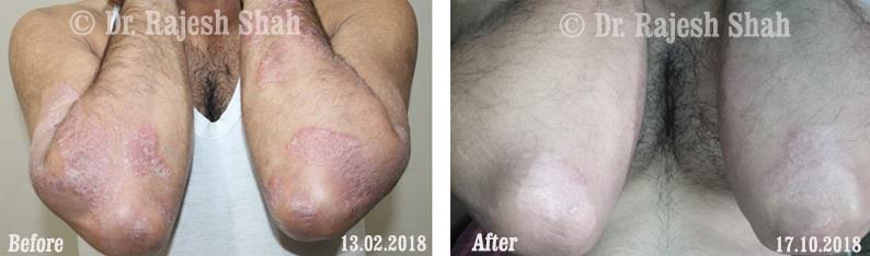 Psoriasis Before and After Case Photo