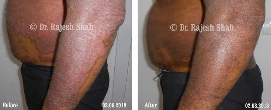Psoriasis Before and After Case Photo