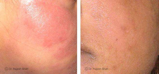 Eczema Before and After Case Photo