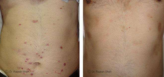 Psoriasis Before and After Case Photo