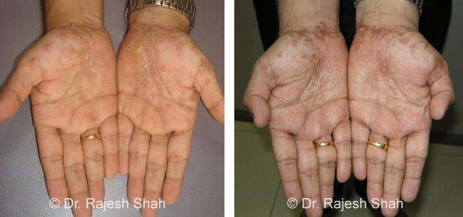 Lichen Planus Before and After Case Photo