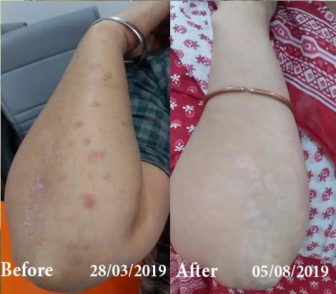 Psoriasis Before and After Case Photo