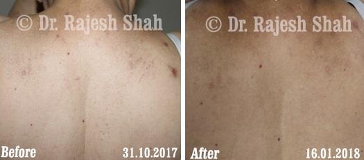 Lichen Planus Before and After Case Photo