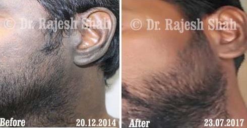 Lichen Planus Pigmentosa Before and After Case Photo