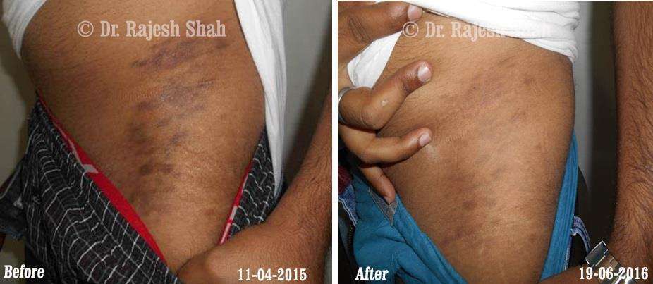 Lichen Planus Pigmentosa Before and After Case Photo