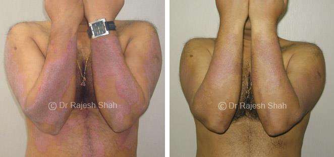 Psoriasis Before and After Case Photo