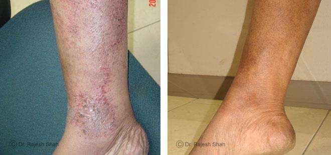 Eczema Before and After Case Photo