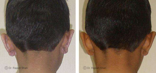 Psoriasis Before and After Case Photo