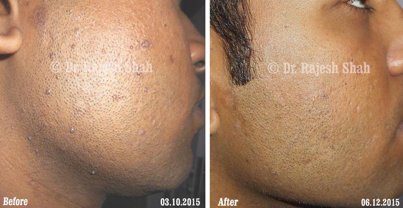 Warts Before and After Case Photo