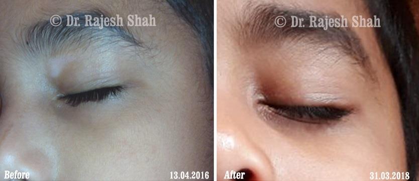 Vitiligo Before and After Case Photo