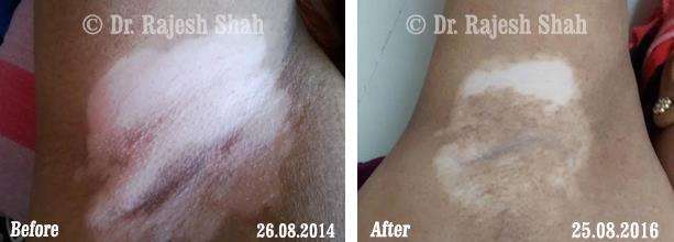 Vitiligo Before and After Case Photo