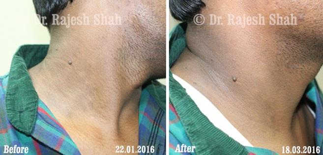 Psoriasis Before and After Case Photo