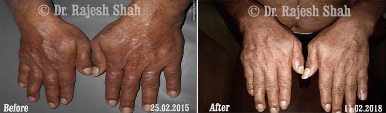 Psoriasis Before and After Case Photo