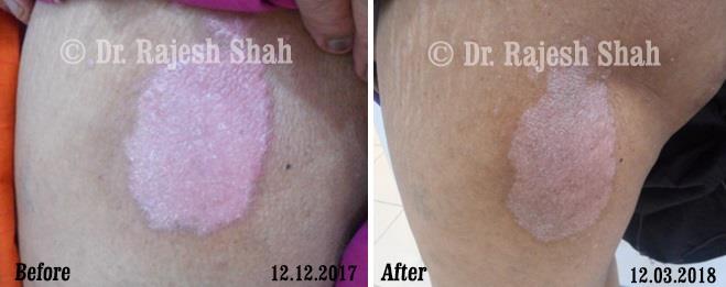Psoriasis Before and After Case Photo