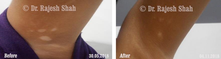 Vitiligo Before and After Case Photo