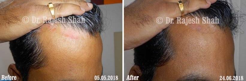 Psoriasis Before and After Case Photo