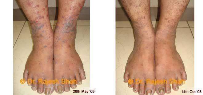 Lichen Planus Before and After Case Photo