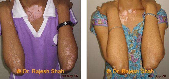 Vitiligo Before and After Case Photo